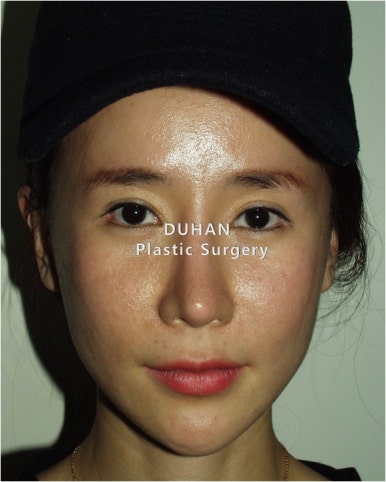 [Duhan Plastic Surgery Double Eyelid Revision] - [Reducing the Double Eyelid Line] image 48