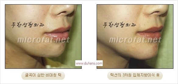 [두한성형외과 경쟁력 안면윤곽 교정] - [자연스럽고 균형있는 턱으로의 복원 미세지방이식과 간편 사각턱 보톡스 안내] 관련 이미지 20