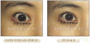 Duhan Plastic Surgery Ophthalmic Reoperation - What Is a Successful Double Eyelid Revision Surgery? image 20