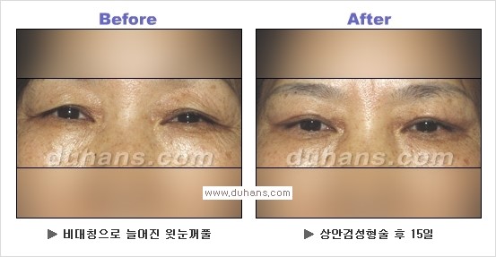 [두한성형외과 경쟁력 눈성형] - [상큼하고 환한 눈매! 상안검 성형(윗눈꺼풀 처짐) 안내] 관련 이미지 9