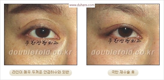 [두한성형외과 경쟁력 눈성형] - [극한 재수술, 함몰된 눈꺼풀 라인교정, 안검하수(졸리운 눈매)] 관련 이미지 28
