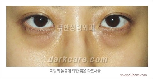 [두한성형외과 경쟁력 눈밑성형] - [다크써클의 원인과 다크써클의 종류] 관련 이미지 10