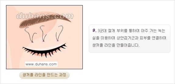 [두한성형외과 경쟁력 눈성형] - [쌍꺼풀 재수술 방법 - 부분절개법(Partial incision method) 과정 안내] 관련 이미지 10