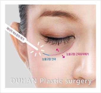 [두한성형외과 경쟁력 눈밑성형] - [눈밑 지방제거 후 눈밑 지방재배치에 의한 교정 안내] 관련 이미지 9
