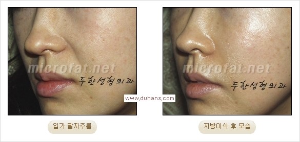 [두한성형외과 경쟁력 주름성형] - [주름 교정을 위한 안전하고 효과적인 미세지방이식] 관련 이미지 13