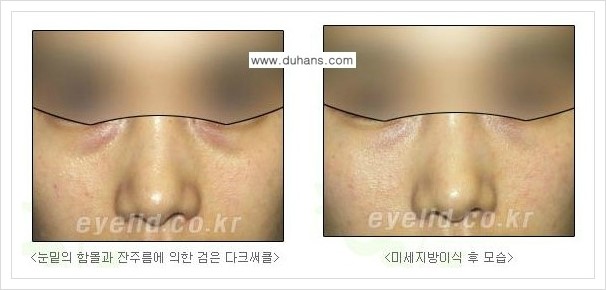 [두한성형외과 경쟁력 다크써클 교정] - [눈밑 돌출이 있으면서 그 아래 함몰 주름선이 있는 증상 개선 방법 안내] 관련 이미지 6