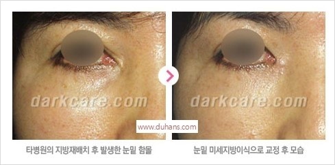 [두한성형외과 경쟁력 눈밑성형] - [다크써클 치료 실패의 원인 - 레이저 치료, 필러로 교정, 잘못된 적응증의 지방재배치] 관련 이미지 5