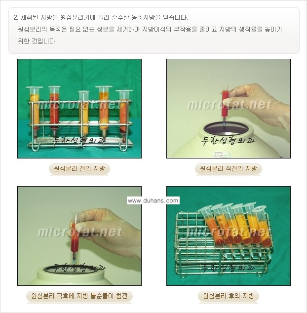 [두한성형외과의 경쟁력 있는 NO.1 지방이식] - [야윈 볼살 미세지방이식] 관련 이미지 8
