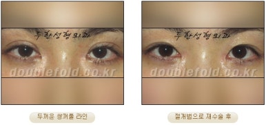 [두한성형외과 쌍커풀재수술] - [심한 소세지눈, 두줄따기, 쌍꺼풀 흉터] 관련 이미지 17