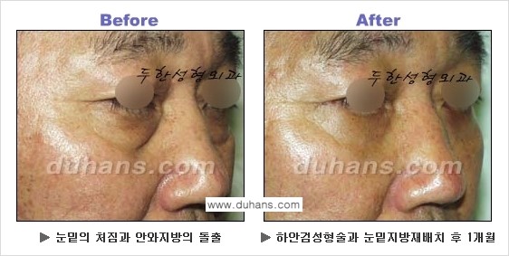 [두한성형외과의 상큼하고 환한 젊은 눈매완성] - [하안검 성형술 ①] 관련 이미지 25
