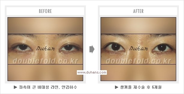 [두한성형외과 경쟁력 쌍꺼풀 재수술, 극한 눈재수술] - [쌍꺼풀 재수술을 위한 검사와 테스트] 관련 이미지 9