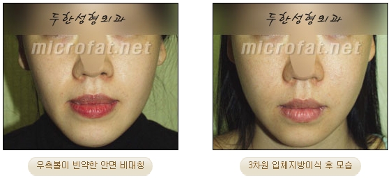 얼굴지방이식 두한성형외과 - 볼지방이식 관련 이미지 29