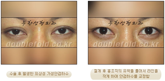 [Duhan Plastic Surgery Double Eyelid Revision Surgery] - [Ptosis, sausage eyelids] image 7