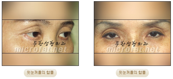 [Doohan Plastic Surgery Autologous Fat Grafting] - [Sunken Eye Fat Grafting] image 2