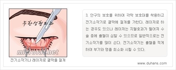 [두한성형외과 경쟁력 눈밑성형] - [눈밑지방제거, 눈위지방제거 안내 1.] 관련 이미지 7