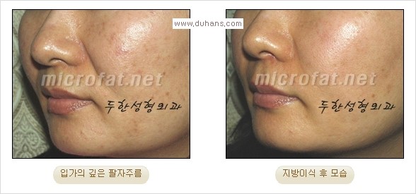 [두한성형외과 경쟁력 주름성형] - [코 옆과 입가에 걸쳐서 형성된 주름을 교정해주는 미세지방이식] 관련 이미지 17