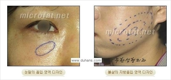 [두한성형외과 경쟁력 미세지방이식] - [타 병원의 지방이식 부작용 교정 - 정교한 마이크로 지방이식, 흡입 안내] 관련 이미지 12