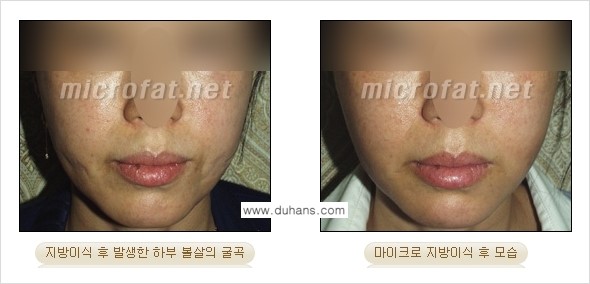 [두한성형외과 경쟁력 미세지방이식] - [미세지방이식 부작용 종류와 교정방법 안내] 관련 이미지 6