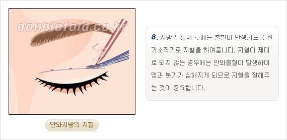 [두한성형외과 경쟁력 쌍꺼풀 재수술, 극한 재수술] - [쌍꺼풀 재수술의 과정 안내 2.] 관련 이미지 11