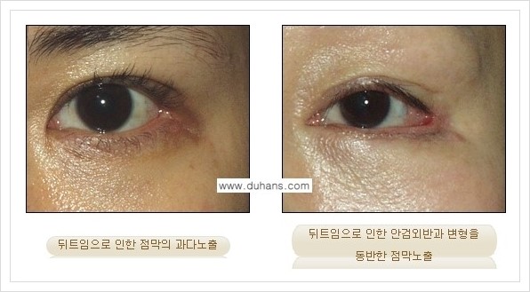 [두한성형외과 경쟁력 쌍꺼풀 재수술, 극한 눈재수술] - [뒤트임 수술의 부작용 및 교정 방법 안내] 관련 이미지 2