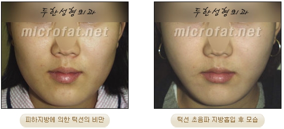 [Duhan Plastic Surgery Liposuction] - [Facial Liposuction] image 23