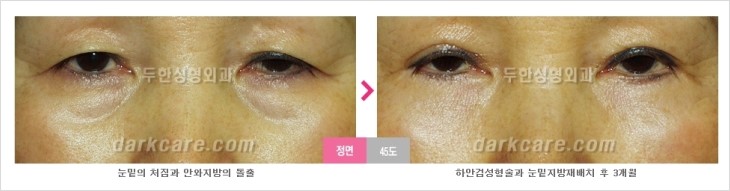 ​[두한성형외과 경쟁력 눈밑성형 리더] - [눈밑 다크써클의 증상, 원인, 종류, 치료방법 안내] 관련 이미지 62