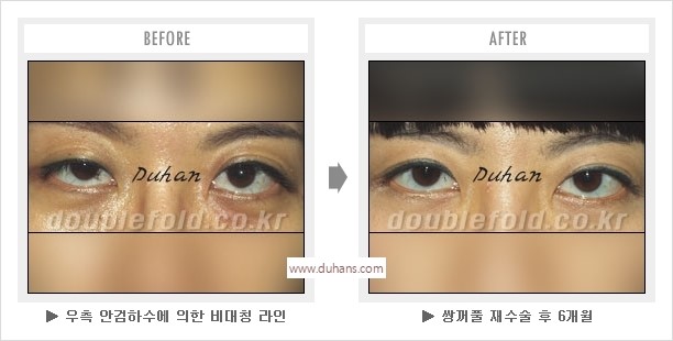 [두한성형외과 경쟁력 눈성형] - [나에게 맞는 어울리는 쌍꺼풀 라인] 관련 이미지 44