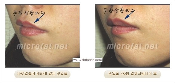[두한성형외과 경쟁력 미세지방이식] - [입술 3차원 입체지방이식 안내 2.] 관련 이미지 8