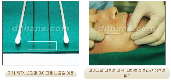 [Duhan Plastic Surgery Facial Autologous Fat Grafting] - [Fat Grafting Guide] image 18