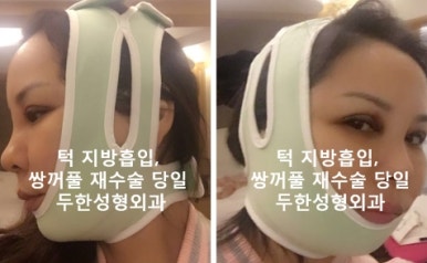[두한성형외과 쌍커풀재수술] - [개인의 눈매와 특성에 맞는 쌍커풀재수술] 관련 이미지 6