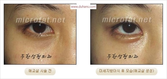 ​﻿[두한성형외과 경쟁력 지방이식] - [눈밑 애교살 시술을 위한 미세지방이식] 관련 이미지 15