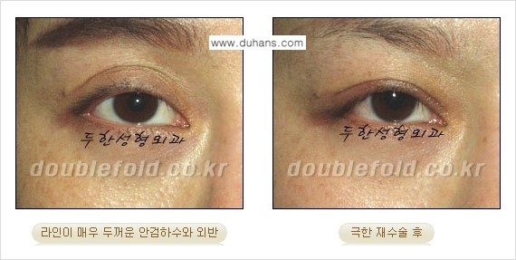 [두한성형외과 경쟁력 눈성형] - [극한의 상태에서 쌍꺼풀재수술(눈재수술) 안내] 관련 이미지 21