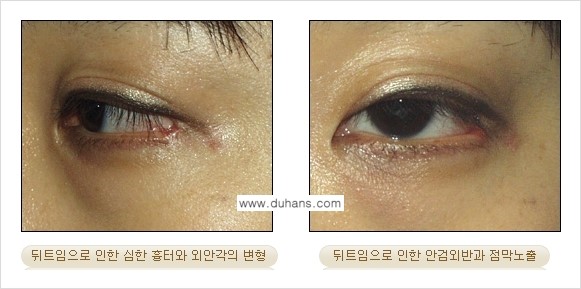 [두한성형외과 NO.1 눈성형] - [뒤트임 수술에 대한 정보] 관련 이미지 5