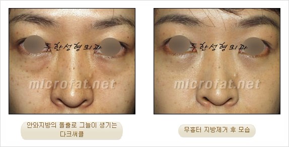 [두한성형외과 쌍커풀수술] - [눈성형 방법에 대한 자주하는 질문과 답변] 관련 이미지 156