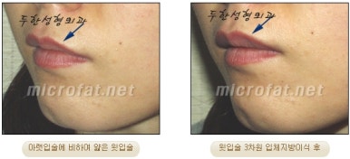 [두한성형외과 입술성형] - [볼륨감 있는 입술 미세지방이식] 관련 이미지 22
