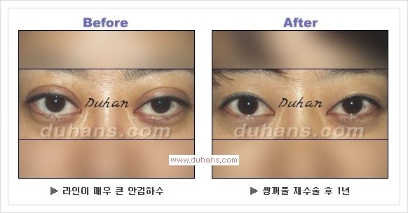 [두한성형외과 경쟁력 눈성형] - [안검하수(졸리운 눈매)의 종류와 교정 방법 안내] 관련 이미지 13