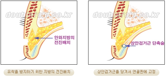 과교정 눈매 (소세지 쌍커풀 재수술, 눈매교정 재수술) 관련 이미지 14