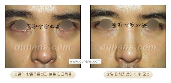 [두한성형외과 FOCUS 눈밑성형] - [다크써클의 치료방법 -  콜펫(Col-fat) 눈밑 미세지방이식 ⑤] 관련 이미지 11