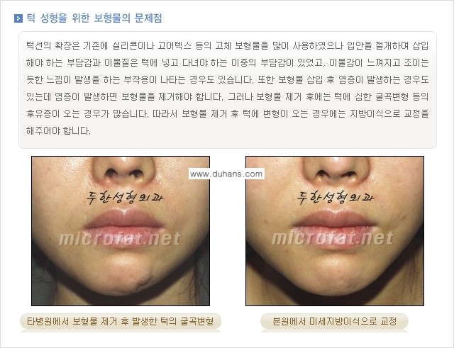 [두한성형외과의 경쟁력 미세지방이식] - [무턱교정 - 턱 미세지방이식 안내 1.] 관련 이미지 8