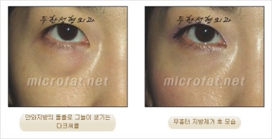 두한성형외과 눈밑수술 - 다크서클 수술 전후 관리 안내 관련 이미지 55