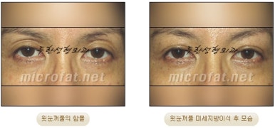 [Doohan Plastic Surgery Autologous Fat Grafting] - [Sunken Eye Fat Grafting] image 20