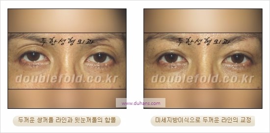 [두한성형외과 경쟁력 눈성형] - [쌍꺼풀 재수술에 대한 최선의 대안 제시] 관련 이미지 24