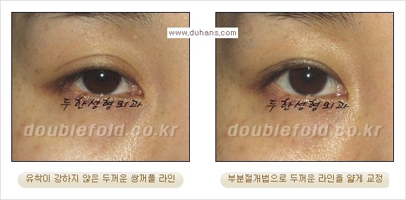 [두한성형외과 경쟁력 눈성형] - [부분절개법(Partial incision method)의 재수술 과정] 관련 이미지 13