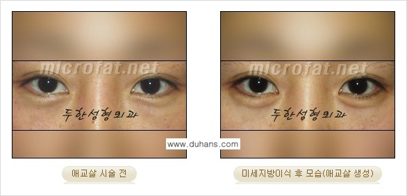 [두한성형외과 무한 경쟁력 눈밑성형] - [애교살 시술 2.] 관련 이미지 2