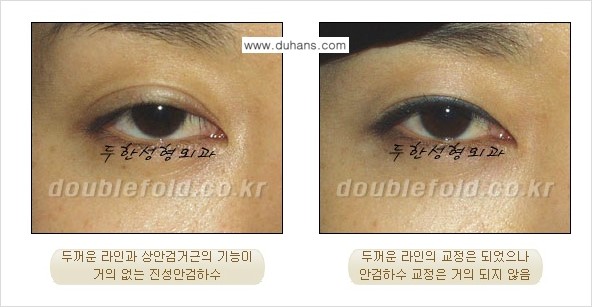 [두한성형외과 NO.1 쌍꺼풀 재수술, 극한 재수술] - [안검하수 교정이 불가능할 경우의 문제점 해결 안내] 관련 이미지 2