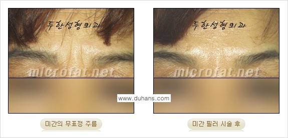 [두한성형외과 경쟁력 퀵성형] - [필러주사(쥬비덤)으로  간단하고 빠르게 주름교정] 관련 이미지 16