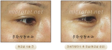 두한성형외과 눈밑성형 - 애교필러 후 눈밑재수술 관련 이미지 41