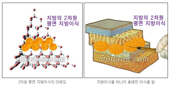 [두한성형외과 주름교정] - [주름개선 지방이식] 관련 이미지 2