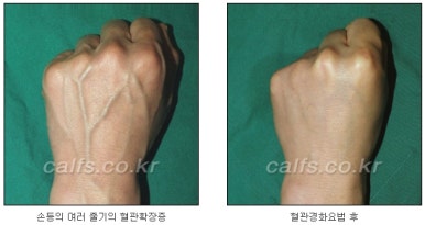 두한성형외과 보기싫은 혈관제거 - 눈밑혈관, 손과 팔의 혈관확장증 치료 관련 이미지 28