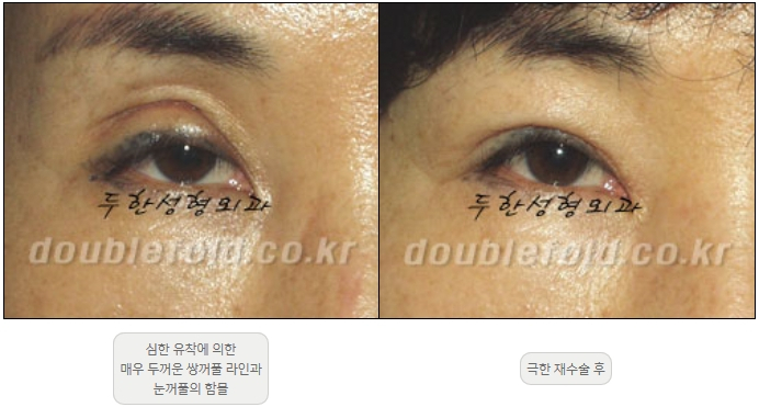 [Duhan Plastic Surgery Double Eyelid Revision] - [Thick Double Eyelid Line] image 33